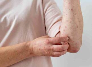 skin allergy on person s arm